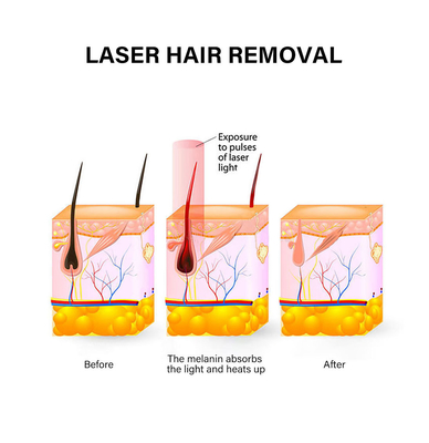 آلة إزالة الشعر الليزر المحمولة 810nm آلة إزالة الشعر الدائمة للنساء