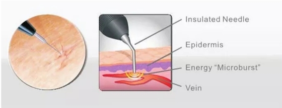 صالون تجميل آلة ليزر 980nm لتهدئة الألم / العلاج الوعائي