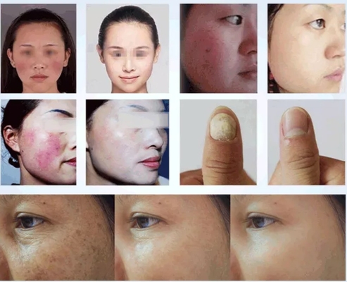 صالون تجميل آلة ليزر 980nm لتهدئة الألم / العلاج الوعائي