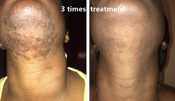 آلة إزالة الشعر بالليزر ذات 4 أطوال موجة 808nm/755 808nm 1064nm مع دليل المستخدم