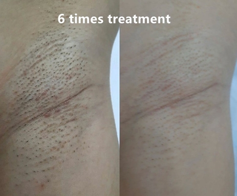 آلة إزالة الشعر بالليزر ذات 4 أطوال موجة 808nm/755 808nm 1064nm مع دليل المستخدم