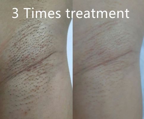 جهاز إزالة الشعر بالليزر متعدد الوظائف يدعم أوسع نبضات مختلفة لتقليص الشعر الدائم المخصص