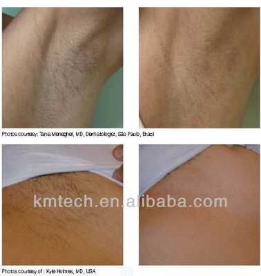 آلة إزالة الشعر بالليزر المهنية
