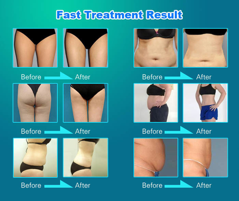 OEM / ODM Vela Slim Machine آلة تشكيل الجسم الاحترافية البيضاء
