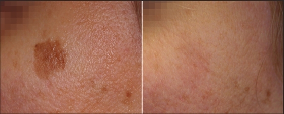 3 في 1 Q Switch ND Yag Laser Machine إزالة الوشم خدمات OEM ODM