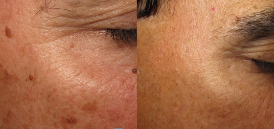 3 في 1 Q Switch ND Yag Laser Machine إزالة الوشم خدمات OEM ODM