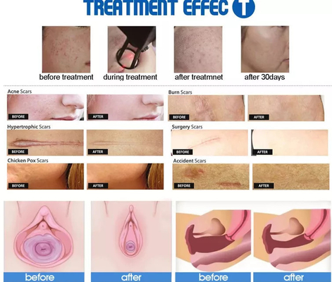 آلة الكسور الليزرية المحمولة من ثاني أكسيد الكربون 40 واط لمحلات التجميل