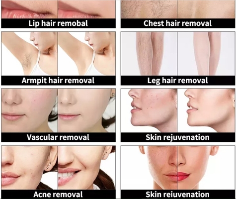 4 في 1 آلة تجميل متعددة الوظائف ثلاثي طول الموجة ليزر آلة إزالة الوشم الشعر