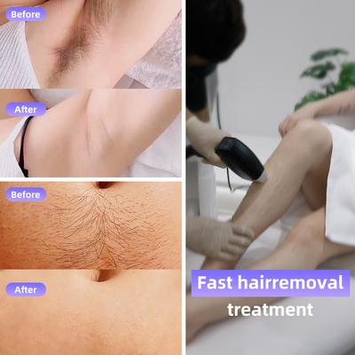 آلة إزالة الشعر بالليزر 808 الديود 4 أبعاد موجة 1064nm مقاس بقعة قابل للتغيير نظام أندرويد