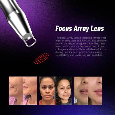 3000W 350PS Picosecond Pico Way ليزر إزالة الصبغة Nd Yag ليزر Picosecond Tatoo إزالة ليزر آلة EU Plug